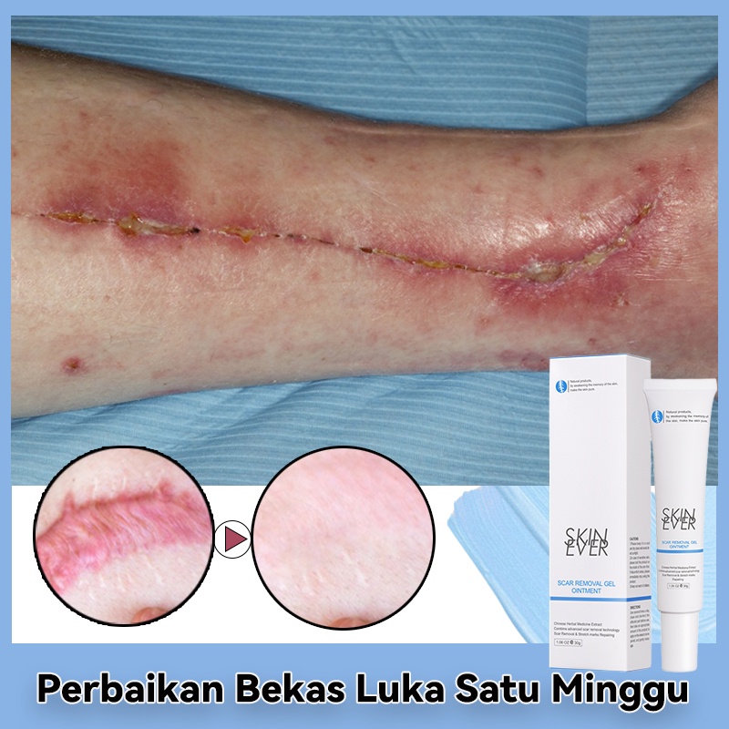 Gel menghilangkan bekas luka krim memudarkan bekas luka memperbaiki jerawat bekas luka lama bekas lu