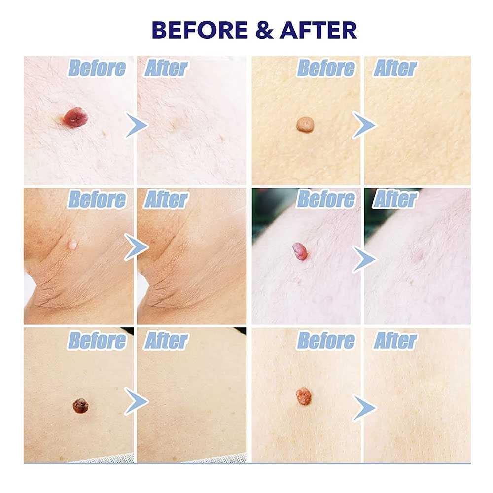 Alat Penghilang Kutil Painless Skin Tag Mole Removal Kit - LGV40 - Blue