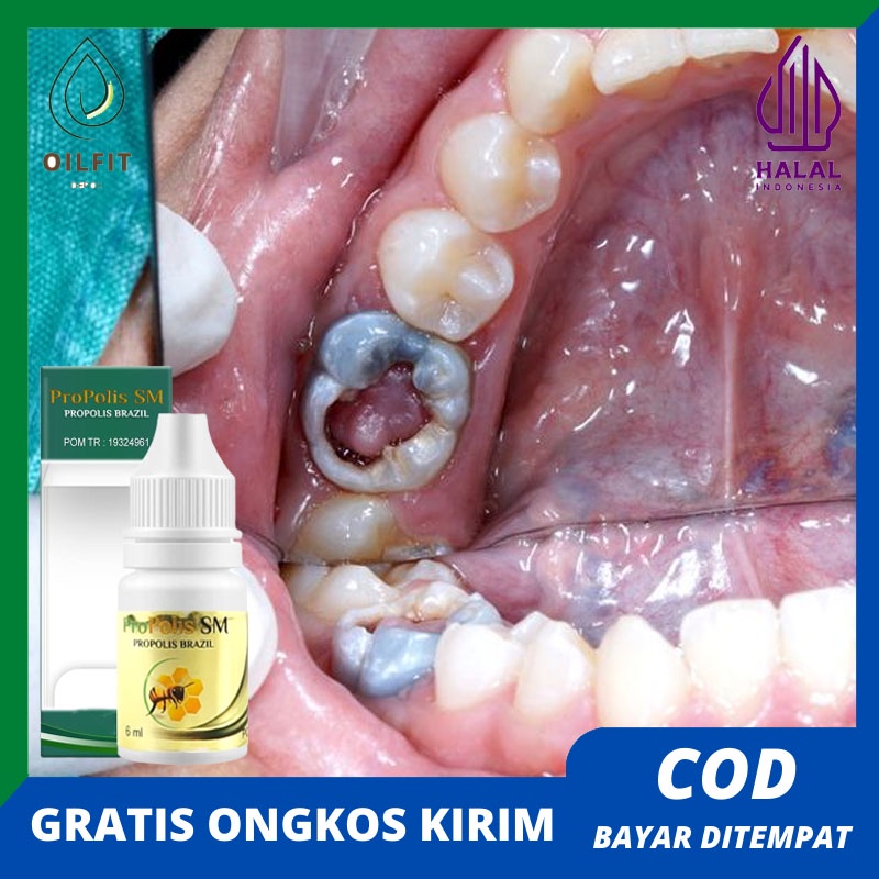 Obat Kumur Polip Gigi Polip pulpa gigi Obat Benjolan pada Gigi Berlubang Tumor Gigi Sakit Gusi