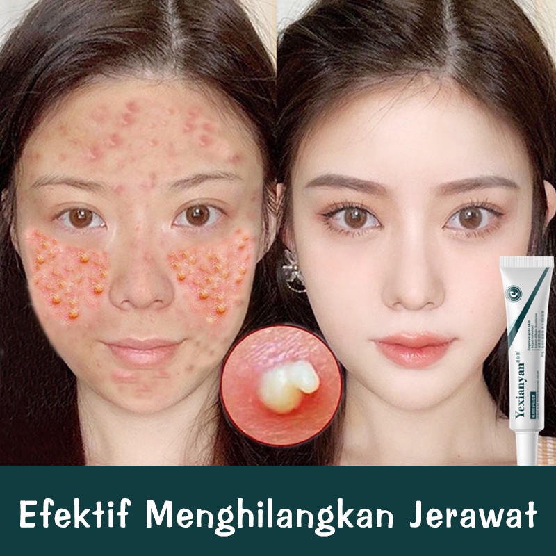 [COD ] Krim menghilangkan jerawat, menghilangkan jerawat, menghilangkan bekas jerawat, jerawat puber