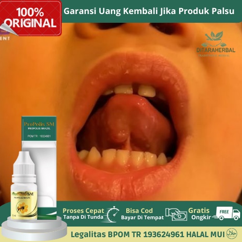 Obat Benjolan Di Bawah Lidah, Obat Penghilang Benjolan Bawah Lidah, Obat Benjolan Di Ujung Lidah, Ob