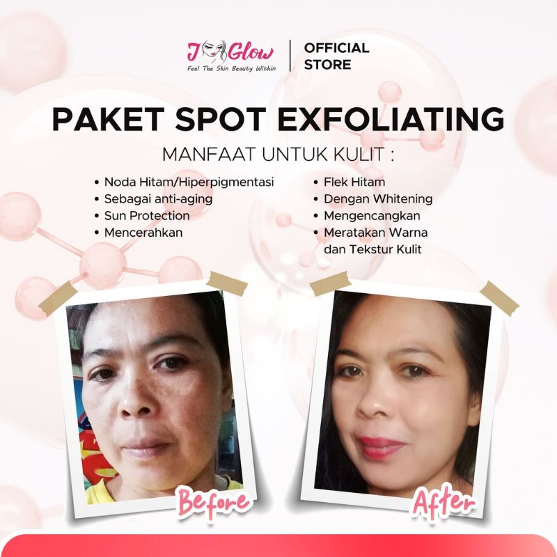 Skincare Jglow Paket Spot Exfoliating Serum Whitening / Rangkaian Skincare Glowing Untuk Perawatan Wajah Flek Hitam dan Noda Hitam Bekas Jerawat  Bpom