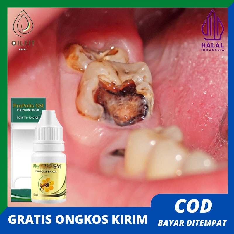 Obat Tetes Sakit Gigi Berlubang Sakit Gigi Nyut Nyutan Gusi Bengkak Untuk Anak dan Dewasa Terlaris