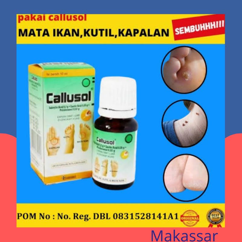 Callusol 10 ml membantu mengatasi mata ikan kutil kapalan