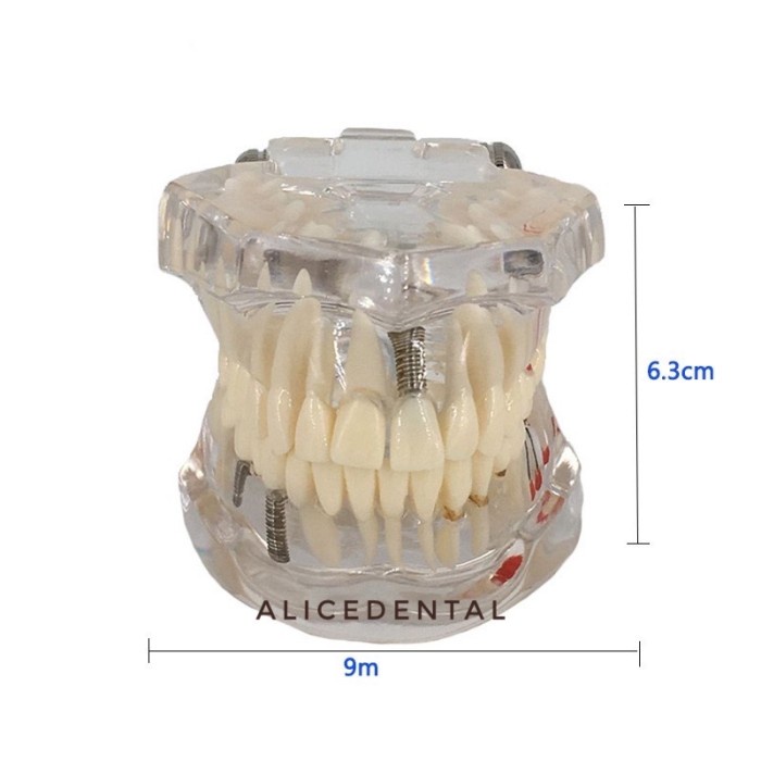 TERLARIS- Model studi gigi implant crown bridge bening transparan phantom dental (NEW)