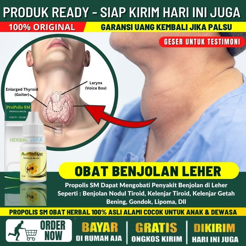 Obat Benjolan di Leher Pada Anak & Dewasa, Obat Herbal Atasi Penyakit Benjolan di Leher, Obat Kelenj