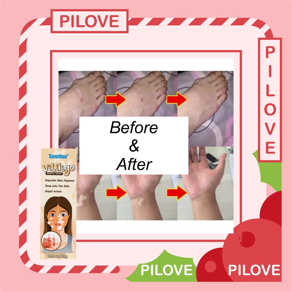 PILOVE - Cream Krim Obat Penghilang Penyembuh Vitiligo Salep Krim Cream Vitiligo Treatment Kulit Bercak Belang Bintik Putih di Bibir Wajah Original Paling Ampuh 100%