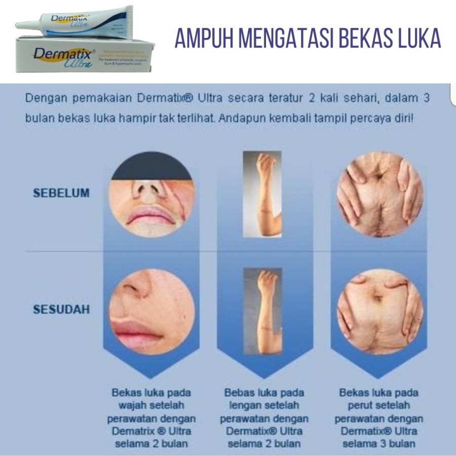 DERMATIX ULTRA GEL SALEP PENGHILANG BEKAS LUKA