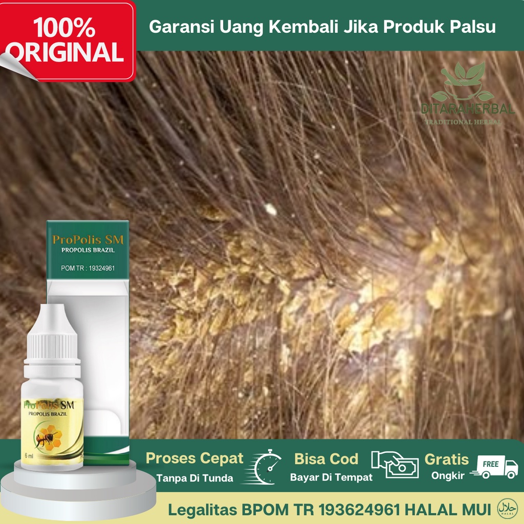 Obat Ketombe Berkerak, Obat Gatal Ketombe Berkerak, Obat Tetes Ketombe Berkerak, Obat Ketombe Tebal,