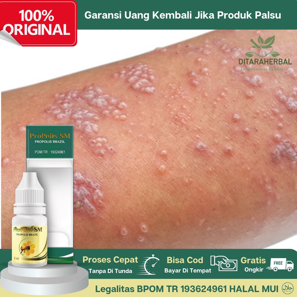 Obat Tetes Gatal Berair, Obat Gatal Bintik Berair, Obat Kutu Air, Obat Gatal Bening Kulit, Obat Gata