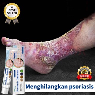 Image of 【100% ORIGINAL】[BPOM&COD]Salep gatal Salep Eksim Salep kulit Krim psoriasis paling ampuh Kulit Kepala Psoriasis Tangan Tinea Kaki Bau Versicolor Menghambat