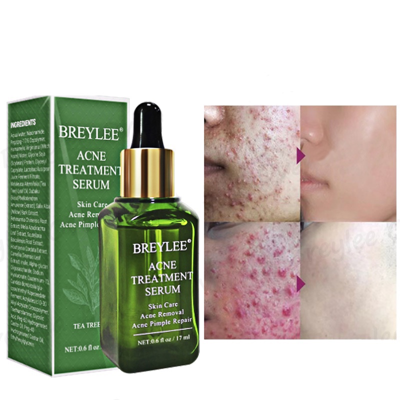 【Baru】ALLPHV Penghilang Komedo Hidung/ Pengangkat Komedo Step 1 &amp; Pore Minimizer Serum Step 2 &amp; Treatment Serum 17mL