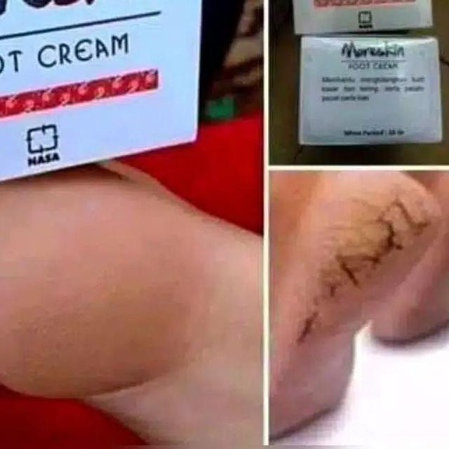 ➸ Kaki pecah dan kering - Kaki pecah - Kaki pecah dan kering ampuh - Kaki pecah2 - Kaki pecah dan cr