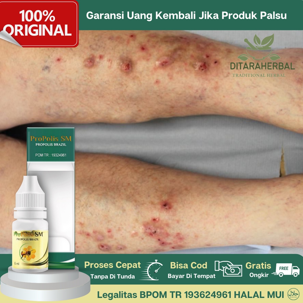 Obat Tetes Koreng Kaki, Obat Gatal Korengan, Obat Penghilang Bekas Korengan, Obat Korengan Menahun, 