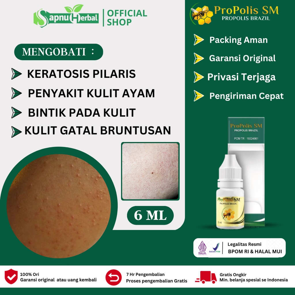 Obat Keratosis Pilaris, Penyakit Kulit Ayam, Penghilang Bintik Pada Kulit, Kulit Gatal Bruntusan, Be
