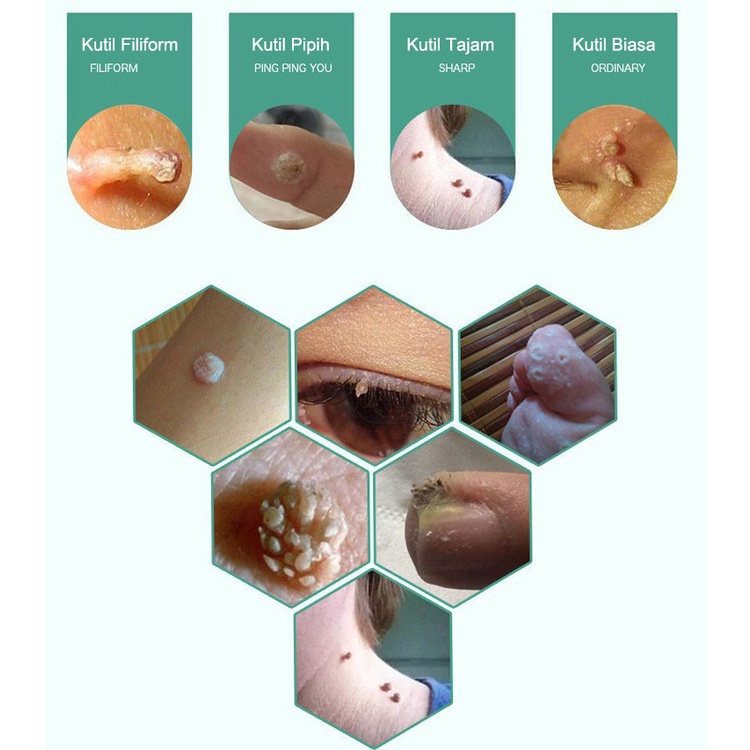Salep kutil obat penghilang kutil penghilang kutil dan tahi lalat 20gr Krim penghilang kutil untuk berbagai bagian tubuh Salep penghilang kutil untuk wajah