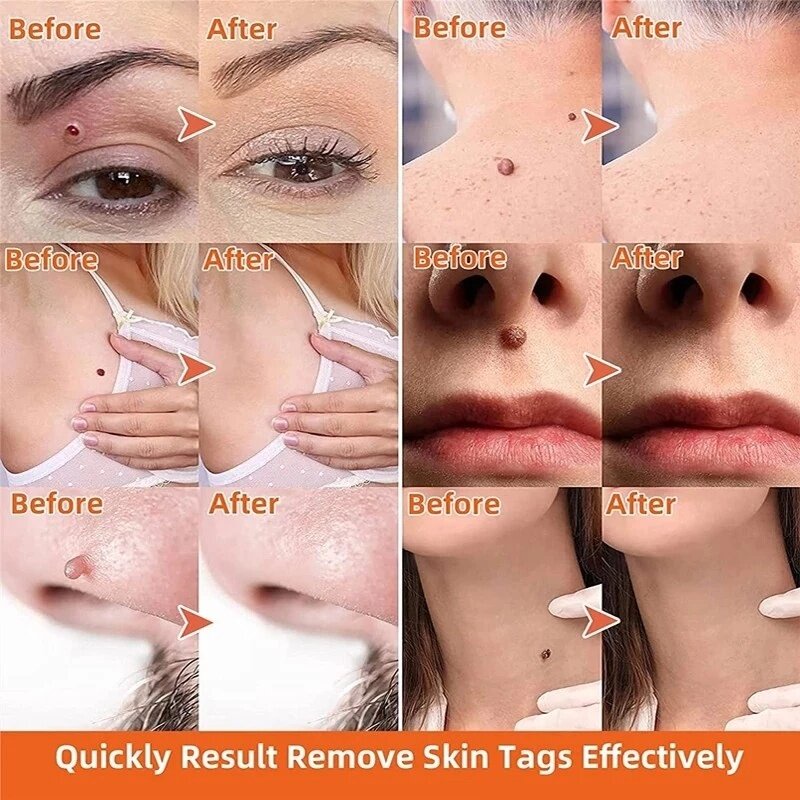 Skin tag remover Obat kutil Wart Remover salep kutil kelamin 20ml skin tag remover obat salep kutil kelamin untuk wajah leher papilloma condyloma acuminatum Warts skin tag