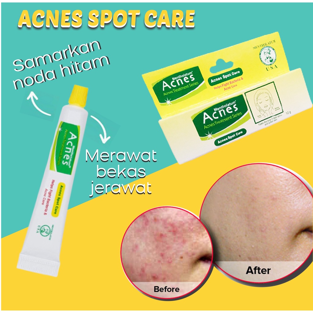 Acnes Spot Care 12 Gr - Obat Penghilang Bekas Jerawat, Flek Hitam, Pencegah Jerawat