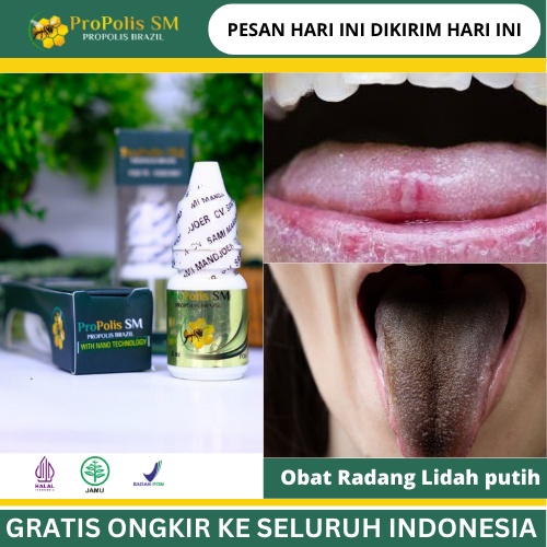 Obat Radang Lidah putih, Obat Lidah Bengkak, Sariawan Mulut, Lidah putih berjamur, Lidah Pecah Pecah