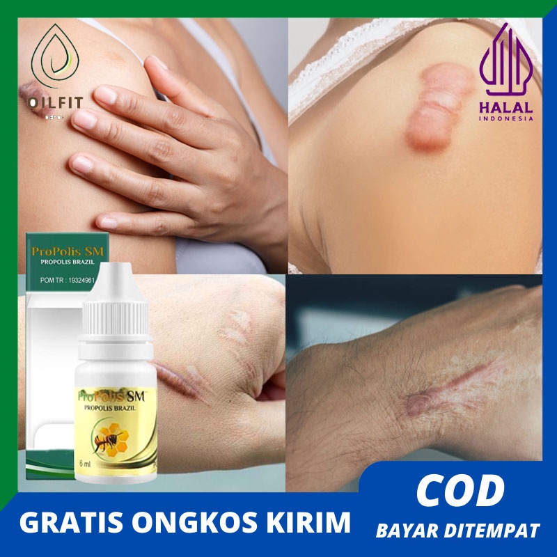 menghilangkan bekas luka obat keloid penghilang bekas luka salep penghilang keloid