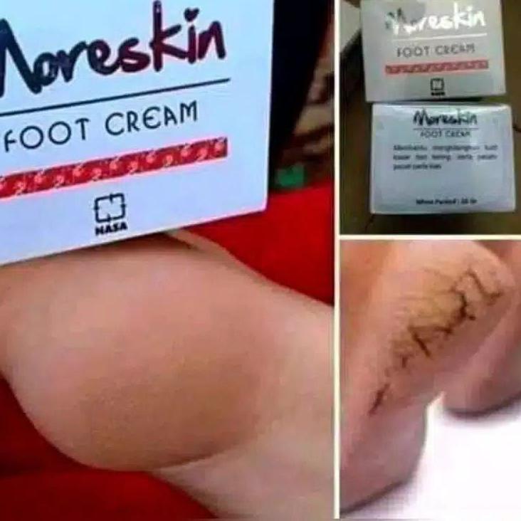 ➸ Kaki pecah dan kering - Kaki pecah - Kaki pecah dan kering ampuh - Kaki pecah2 - Kaki pecah dan cr