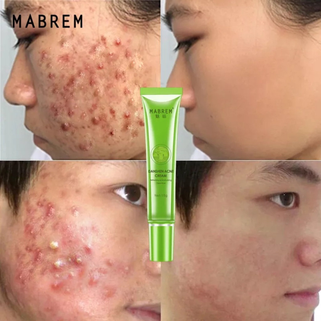 ORI 100% MABREM Krim Jerawat Perbaikan Perawatan Jerawat Mengontrol Minyak/Krim Penghilang Jerawat d