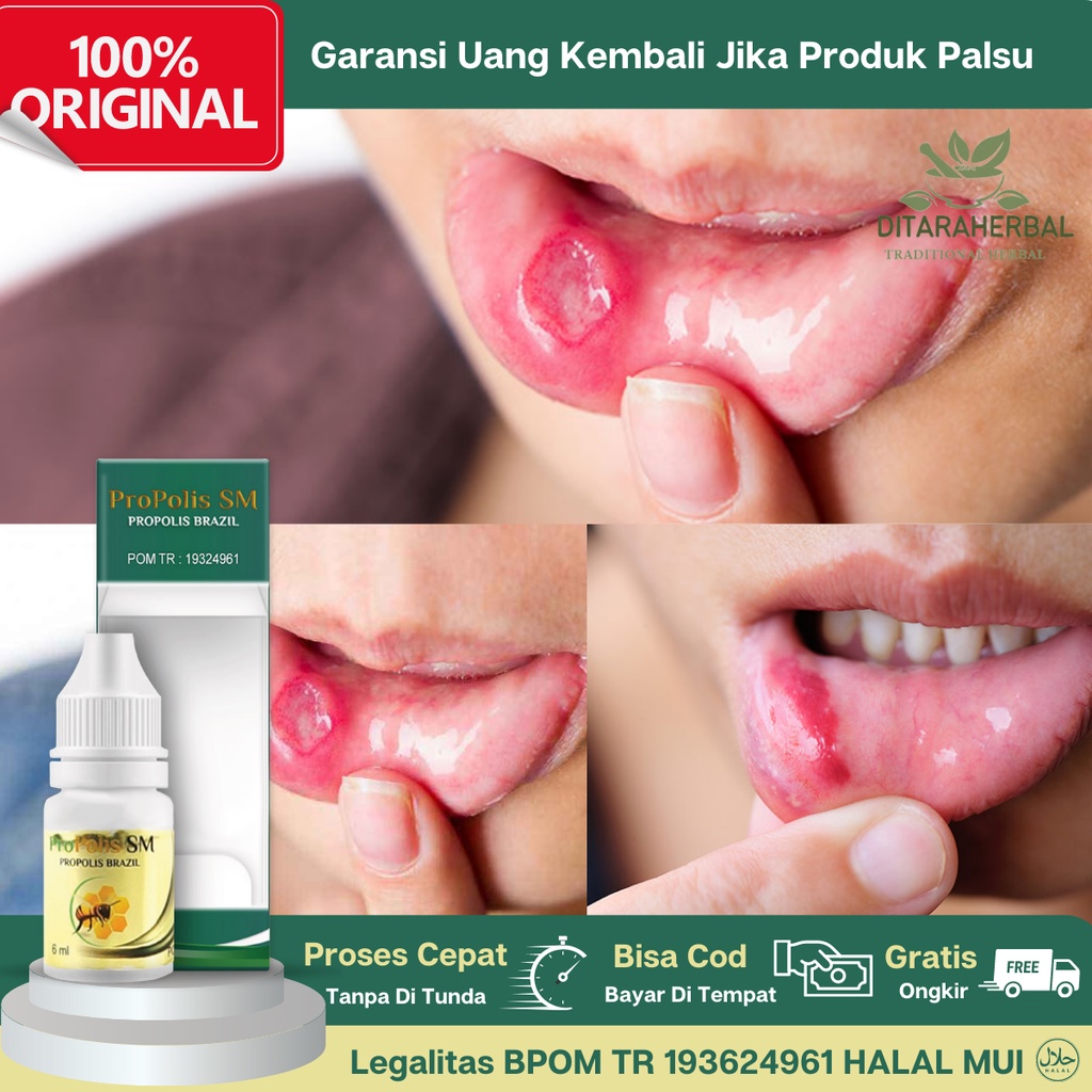 Obat Sariawan, Obat Tetes Sariawan, Obat Luka Sariawan, Obat Oles Sariawan Mulut, Obat Sariawan Peri
