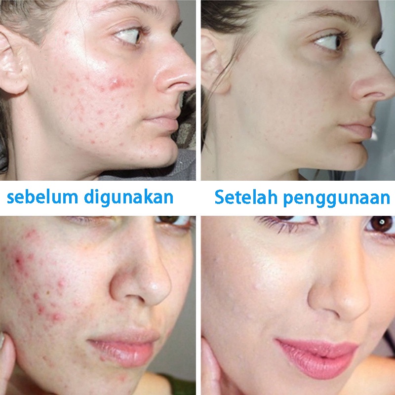 krim jerawat acne jerawat cream jerawat 30ml Krim esensi herbal anti jerawat sangat memperbaiki bekas jerawat dan memperbaiki kulit