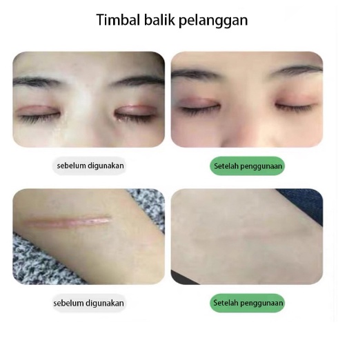 Penghilang Bekas Luka Wajah / Penghilang Bekas Luka Hitam Koreng