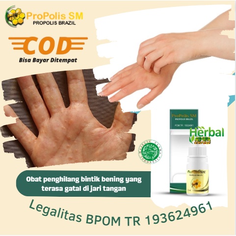Obat penghilang bintik bening yang terasa gatal di jari tangan - dermatitis kontak alergi, pompholyx