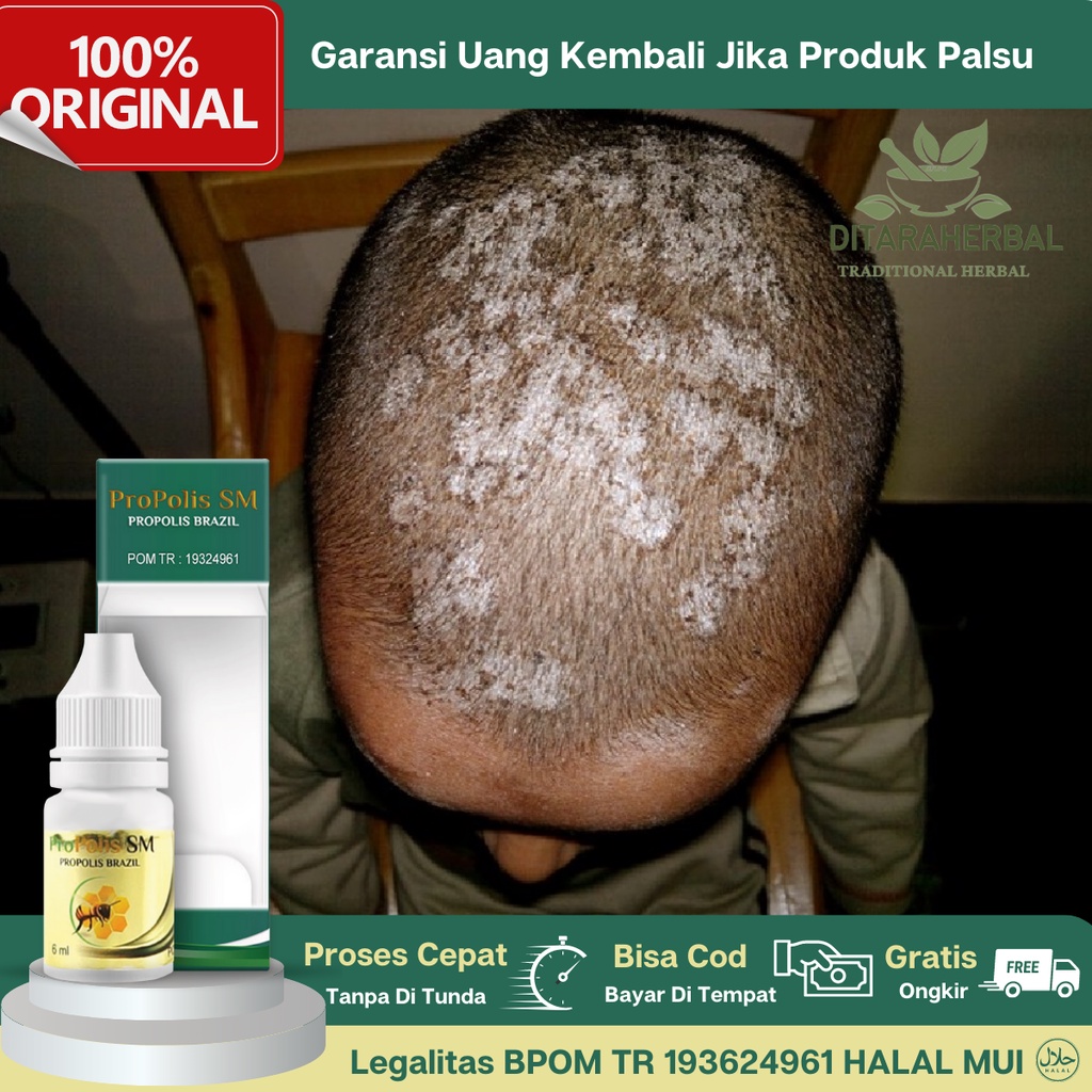 Obat Kurap Di Kepala, Obat Gatal Kurap Kepala, Obat Infeksi Kulit Kepala, Obat Infeksi Jamur Kepala,