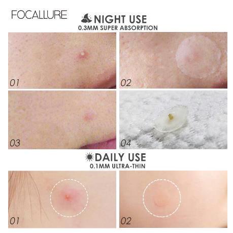 * NCC * Focallure Acne Pimple Patch Treatment Jerawat Day Or Night FA186