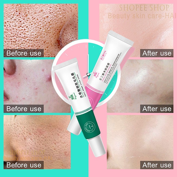 Acne gel jerawat Mengecilkan Pori pori besar Serum wajah 30G Menyegarkan kontrol minyak komedo mengecilkan pori-pori Meningkatkan jerawat dan kulit kasar Melembabkan dan meremajakan Menghilangkan jerawat, komedo, pori-pori besar