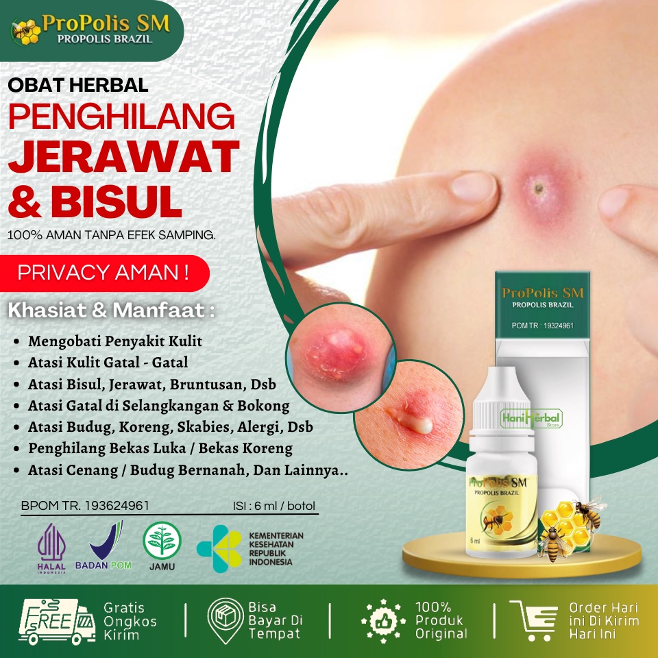 Obat Bisul Alami, Obat Bisul Agar Pecah dan Kering, Obat Bisul Biar Gak Tumbuh Lagi, Obat Bisulan, S