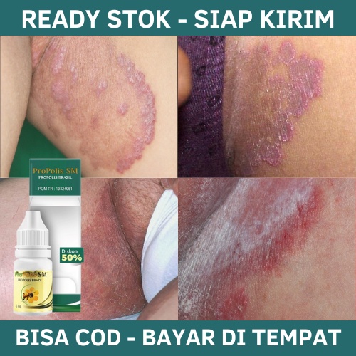 Obat Penghilang Hitam Dan Gatal di Selangkangan - Obat Gatal Pada Selangkangan, Obat Selangkangan Le