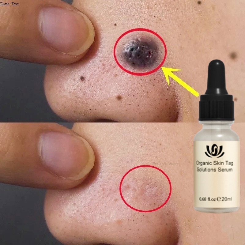 Penghilang Tahi Lalat Penghilang Kutil Skin Tag Remover Flek Dan Bintik Menghilangkan Pigmen Hitam K