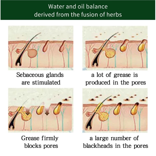 Acne gel jerawat Mengecilkan Pori pori besar Serum wajah 30G Menyegarkan kontrol minyak komedo mengecilkan pori-pori Meningkatkan jerawat dan kulit kasar Melembabkan dan meremajakan Menghilangkan jerawat, komedo, pori-pori besar