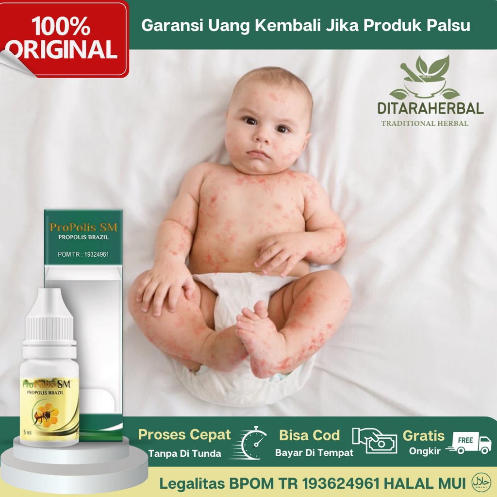 Obat Iritasi Kulit Bayi, Obat Iritasi Ruam Popok, Obat Ruam Merah Kulit Bayi, Obat Oles Ruam Lipatan