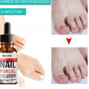 Terlaris Jamur Kuku Paling Ampuh, Obat Kuku Rusak Busuk Berjamur Infeksi kuku