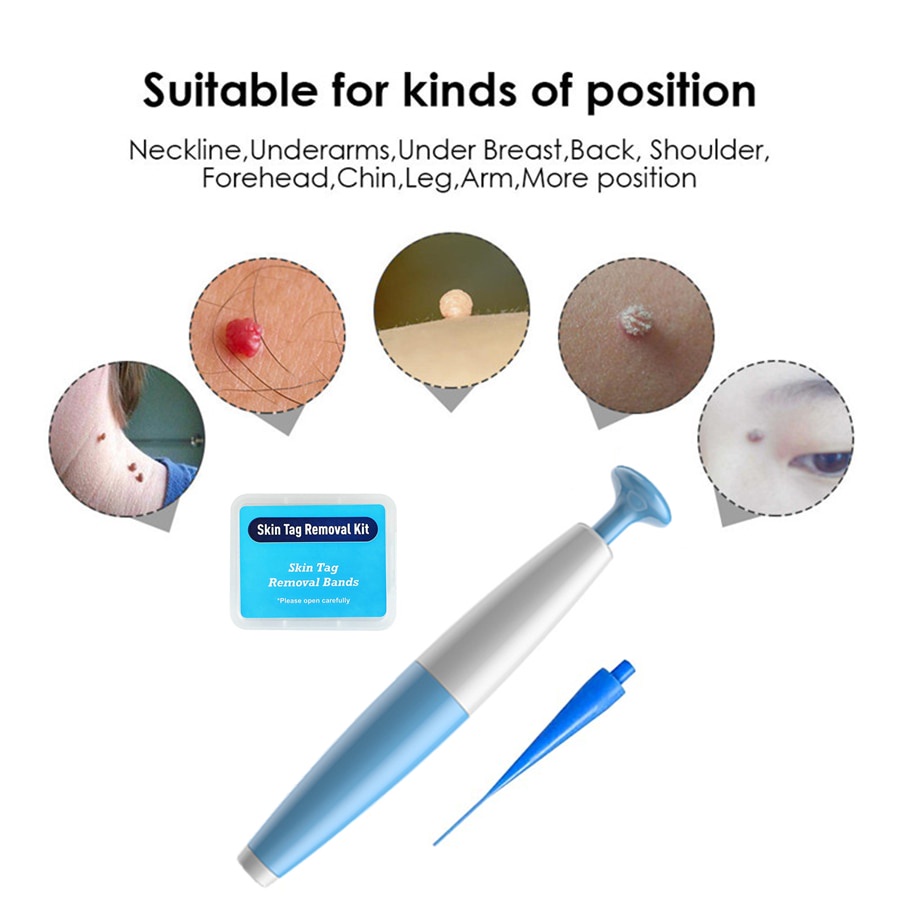 Alat Penghilang Kutil Painless Skin Tag Mole Removal Kit - LGV40 - Blue