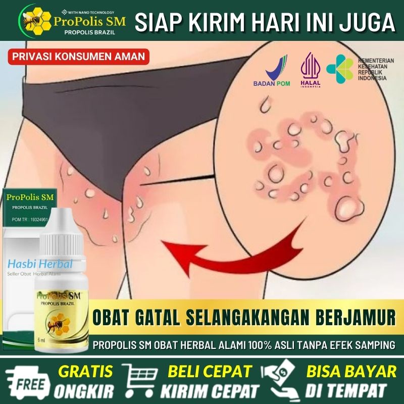 Salep Tinea Cruris Anak & Dewasa, Salep Alami Gatal Selangkangan, Obat Ruam Merah di Selangkangan, O