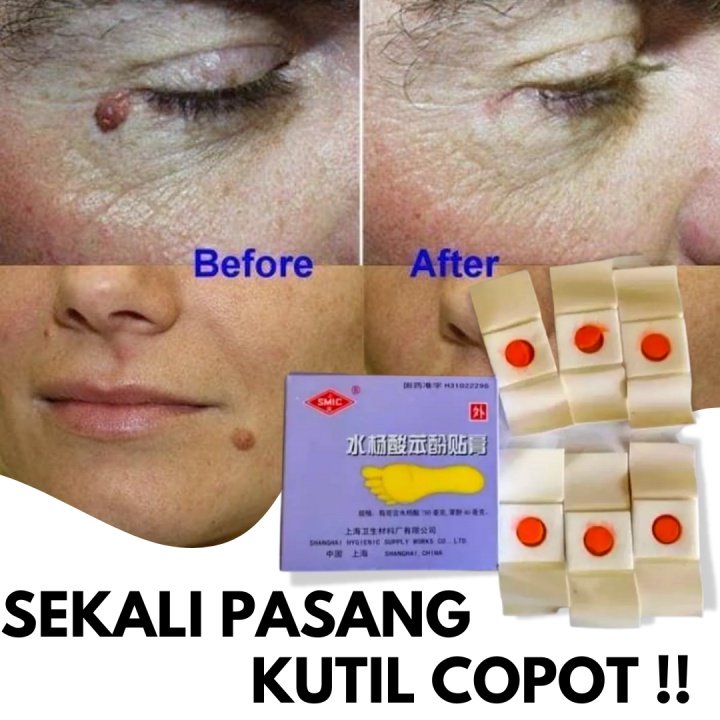 Ji Yan Gao Paling Ampuh Hansaplast Plester Obat Kutil / Mata Ikan / Kapalan