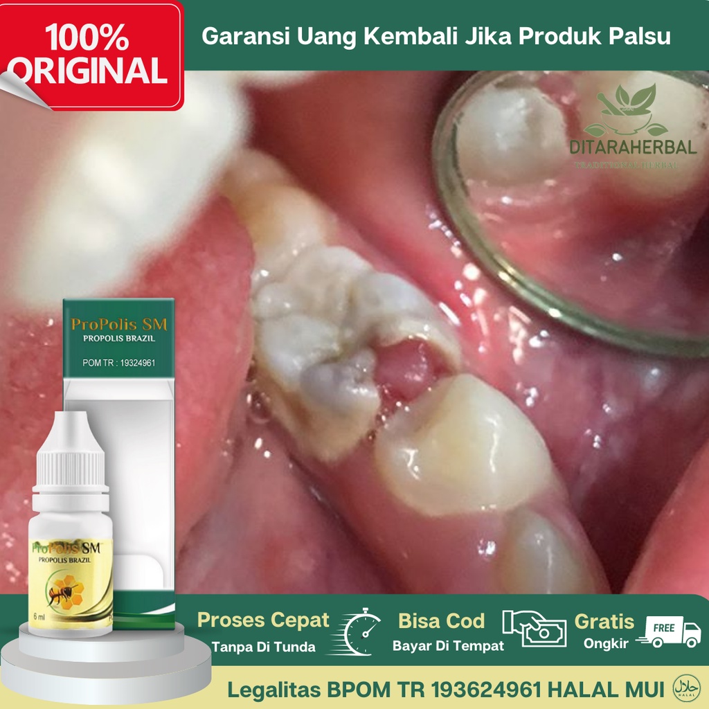 Obat Polip Pulpa Gigi, Obat Tetes Polip Gigi, Obat Penghancur Polip Gigi, Obat Nyeri Polip Gigi, Oba