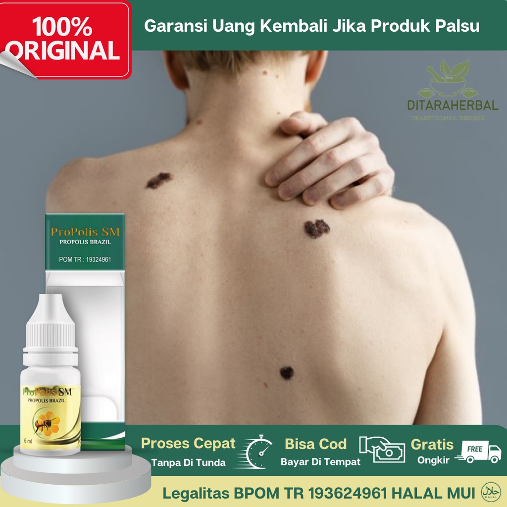 Obat Penghilang Tahi lalat - Penghilang tahi lalat di wajah -Obat Penghilang Kutil dan Tahi lalat - 