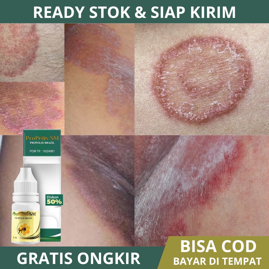Obat Selangkangan Hitam, Obat Gatal Selangkangan, Obat Selangkangan Bersisik, Obat Selangkangan Berj