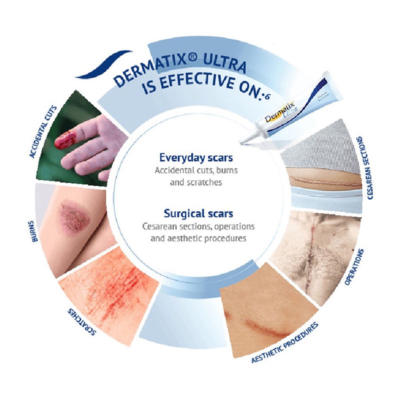 Dermatix Ultra Cream 15gr Penghilang Bekas Luka Operasi Keloid - Luka Lama - Bakar - Gatal Koreng Dermatik Dermatic Usa Original