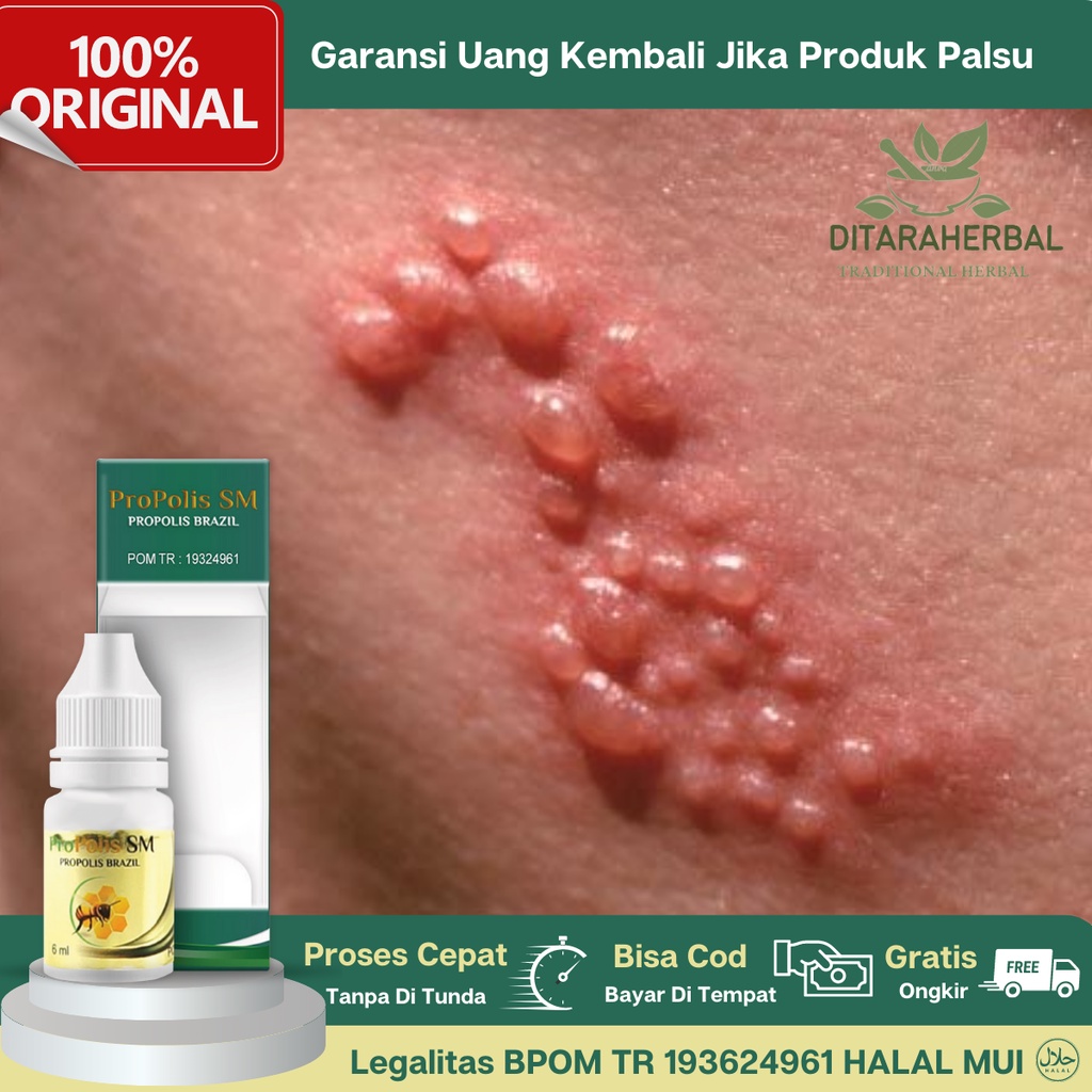 Obat Tetes Gatal Berair, Obat Gatal Bintik Berair, Obat Kutu Air, Obat Gatal Bening Kulit, Obat Gata