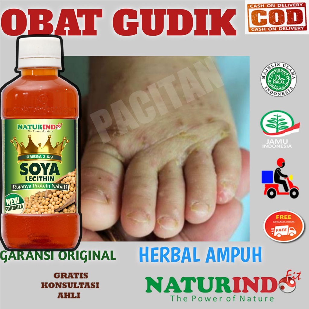 OBAT GUDIK OLES KUDIS KURAP GATAL DI KULIT GATAL ALERGI HERBAL PALING AMPUH NATURINDO BPOM COD