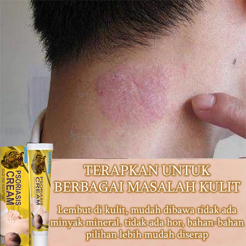 Salep Gatal Obat Gatal Kulit 20g Kulit Kepala Psoriasis Tangan Tinea Kaki Bau Versicolor Menghambat Dermatitis Jamur Salep Gatal Paling Ampuh