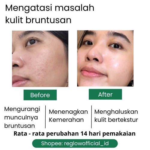 Toner Reglow dr Shindy Skincare Acne Perawatan Penghilang Jerawat Bruntusan Skincare Untuk Kulit Sensitif Berminyak Rglow Original Official Store